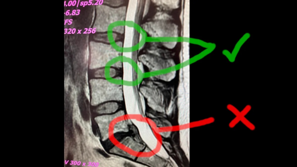 MRI scan of my spine showing a spinal disc hernia, bulging out and pushing against the spinal nerve.